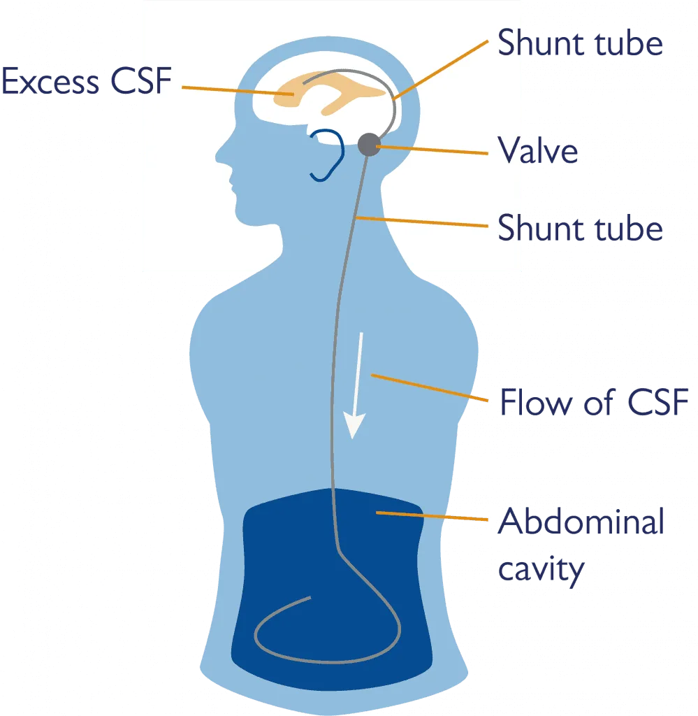 Shunt system in body.